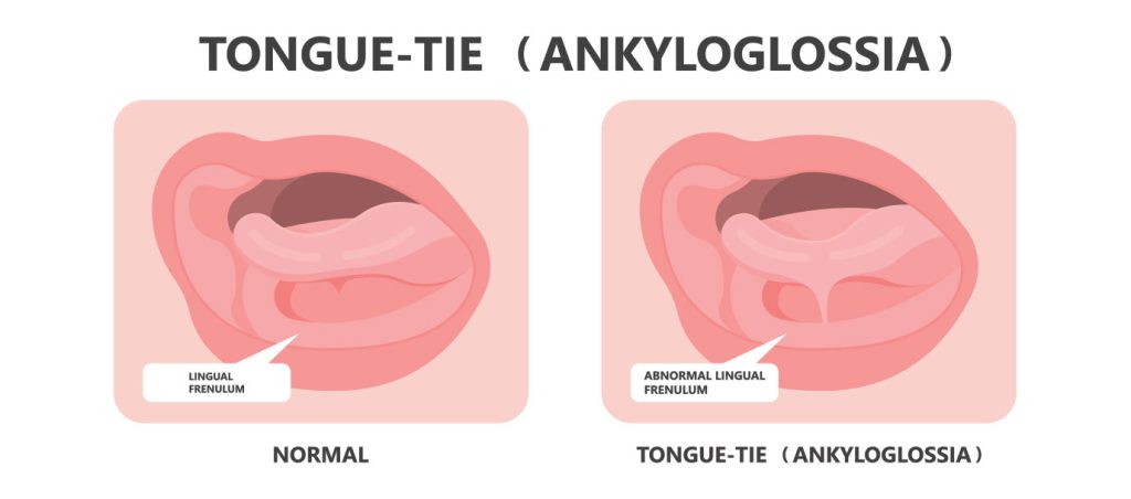 Unlocking Smiles: Understanding Tongue Tie in Kids Dentistry